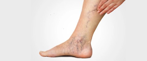 Φλεβίτιδα και η Συμβολή των Φλαβονοειδών