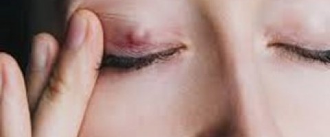 Πώς να αντιμετωπίσετε το Χαλάζιο - Νέες κατευθυντήριες για όλους τους πάσχοντες